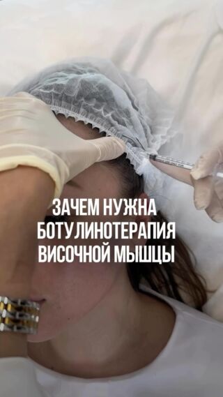 Ботулинотерапия височных мышц позволяет профилактировать мигрени и головные боли.

Процедура должна выполняться именно в методике full face. Это гарант:

• Красивого и естественного эстетического результата.
• Выраженной профилактики старения.
• Лимфодренажа.
• Отсутствия побочного эффекта в виде компенсации мышц.

Записаться на ботулинотерапию full face можно через администратора VOXX Clinic: +7 (495) 760-06-14

#ботулинотерапия #ботулинотерапиямосква #ботокс #диспорт #релатокс #релатоксмосква #миотокс #ксеомин #ботокслица #омоложениелица #омоложениелицамосква #косметологмосква #морщиныналбу #морщинывокругглаз #клиникапавелецкая