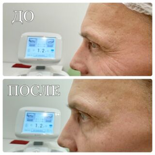 👌🏻 На фото видно какой гладкой стала кожа лица после процедуры SMAS-лифтинга на Ultraformer lll: 

~ ушли сильно выраженные мимические морщины
~ разгладились мелкие статические морщинки около глаз 
☺️ Лицо выглядит свежим и молодым!

Понравился результат?
Записывайтесь на прием!
Ставьте❤️ 

#ультраформер #смаслифтинг #коррекцияморщин #косметологмосква #клиникапавелецкая