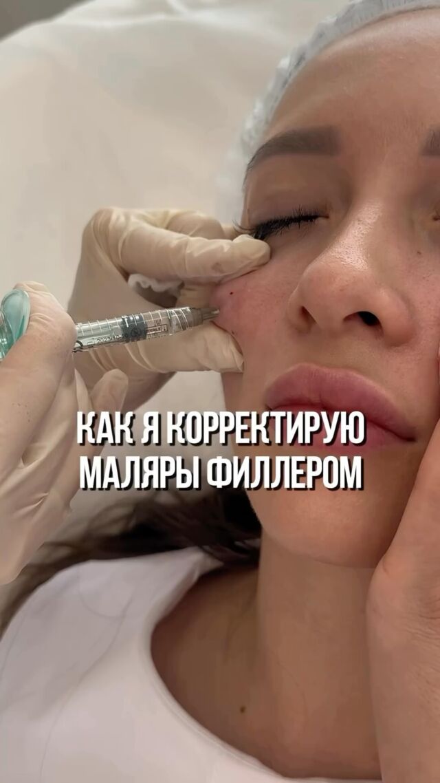 Контурная пластика при наличии малярных мешков — это финишная процедура. Техника от ведущего косметолога.

Так ей предшествуют:

• Ботулинотерапия Full face для профилактики отечности филлера и лимфодренажа зоны вокруг глаз.
• Ультразвуковой SMAS-лифтинг с целью компактизации жировых пакетов.
• Сепарация канюлей. Редкая процедура, но в некоторых случаях крайне необходимая. 

Все процедуры выполняются по показаниям. Но именно такая тактика позволяет решить проблему малярных мешков ✨

#малярныемешки #контурнаяпластика#контурнаяпластикагуб #контурнаяпластикамосква#филлеры #филлерымосква #филлерыдлягуб#усталостьлица #мешкиподглазами#мешкиподглазамиубрать #омоложениелица#омоложениебезуколов #омоложениебезопераций#какомолодитьлицо #лифтинглица#каквернутьмолодость #врачкосметолог#врачкосметологмосква